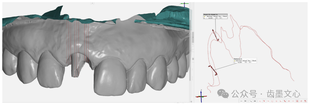 “裤子技术”：种植体围手术期软组织增大术的新方法