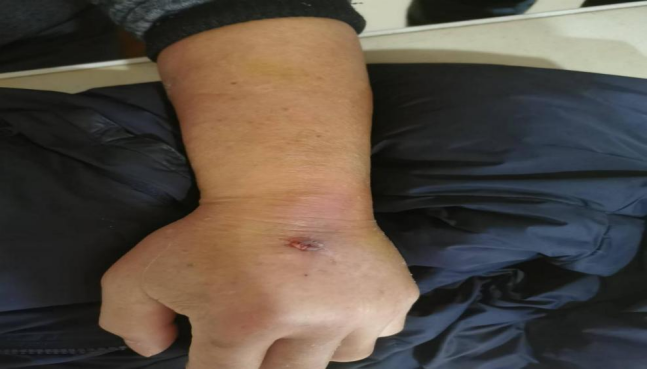 为什么输液要盖块纱布护士请警惕！输液留置针竟引发静脉血栓！？_https://www.jmylbn.com_新闻资讯_第2张