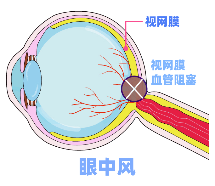 6969眼部血管遇冷收缩,血流变缓,易造成视网膜动脉阻塞,即所谓的