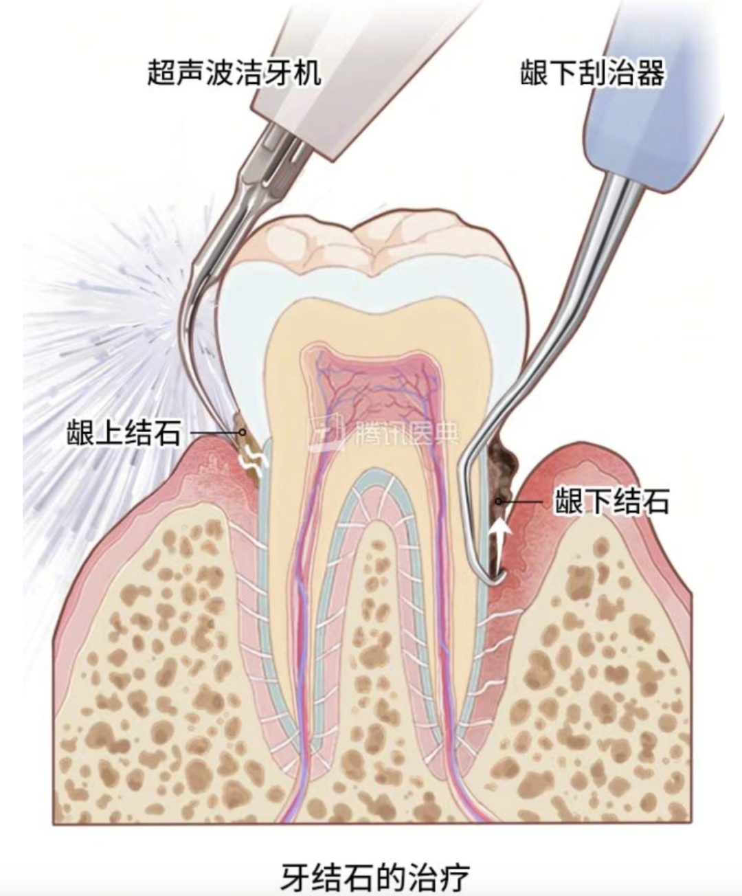 口臭的人为什么自己闻不到