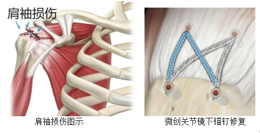 什么品牌的关节镜好品牌技术 ｜ 骨科医生巧用关节镜，解决患者肩关节疼痛的困扰_https://www.jmylbn.com_新闻资讯_第9张
