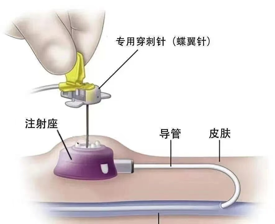什么是port手术胸前小徽章 隐形生命线｜一文读懂输液港，告别反复穿刺痛苦！-上海聚慕医疗器械有限公司