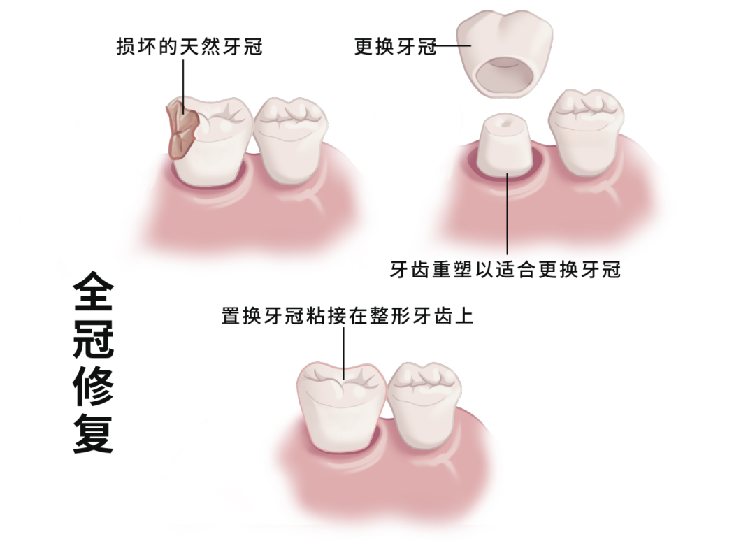 牙冠修复 4.6.png