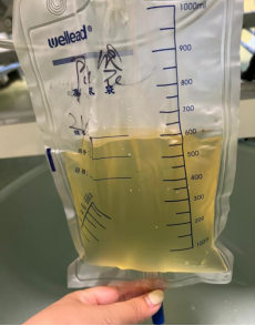 尿液引流袋怎么用带管回家之—导尿管的居家护理_https://www.jmylbn.com_新闻资讯_第6张