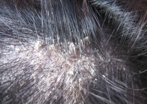 头部脂溢性皮炎头皮怎么治疗？