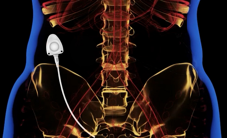 电子输注泵起什么作用输液港只能静脉输液吗？它用途可大了！_https://www.jmylbn.com_新闻资讯_第6张