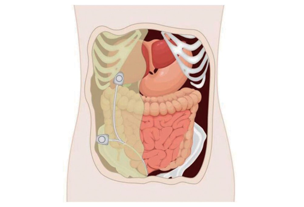 电子输注泵起什么作用输液港只能静脉输液吗？它用途可大了！_https://www.jmylbn.com_新闻资讯_第7张