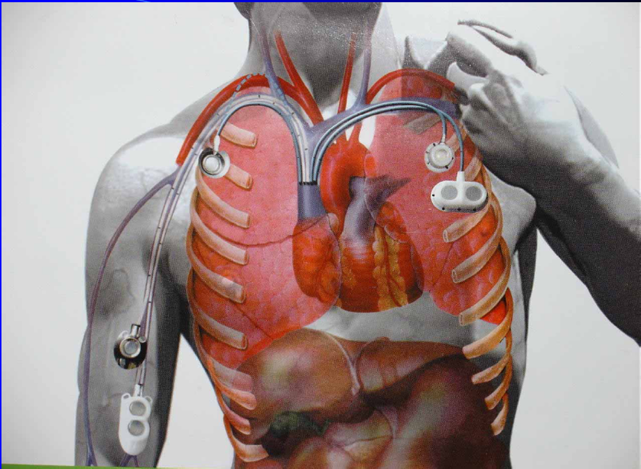 电子输注泵起什么作用输液港只能静脉输液吗？它用途可大了！_https://www.jmylbn.com_新闻资讯_第2张