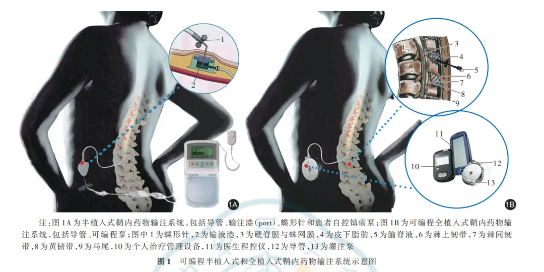 电子输注泵起什么作用输液港只能静脉输液吗？它用途可大了！_https://www.jmylbn.com_新闻资讯_第8张