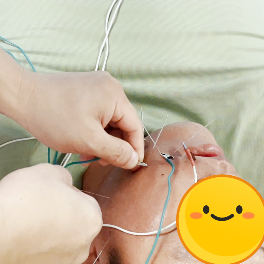 电针理疗是什么中医理疗与现代康复，助力面神经受损痊愈！_https://www.jmylbn.com_新闻资讯_第11张