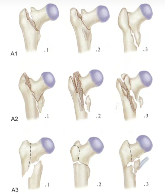 股骨粗隆间骨折PFNA内固定的4大关键总结，实用！
