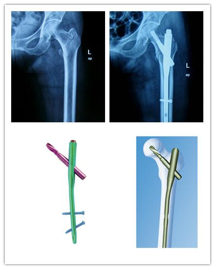 股骨粗隆间骨折PFNA内固定的4大关键总结，实用！