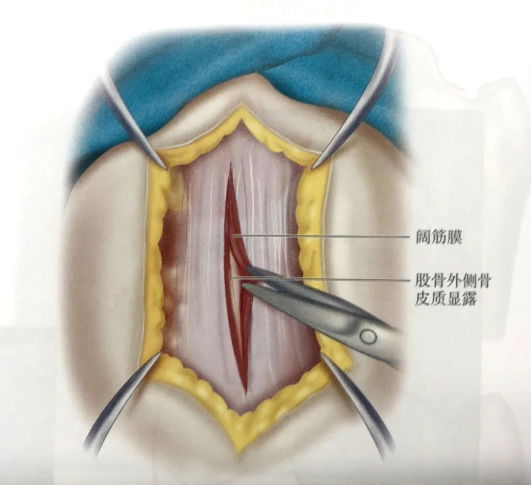 股骨粗隆间骨折PFNA内固定的4大关键总结，实用！