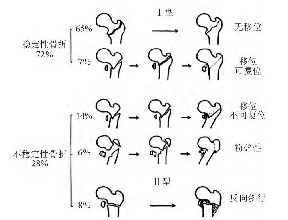 股骨粗隆间骨折PFNA内固定的4大关键总结，实用！