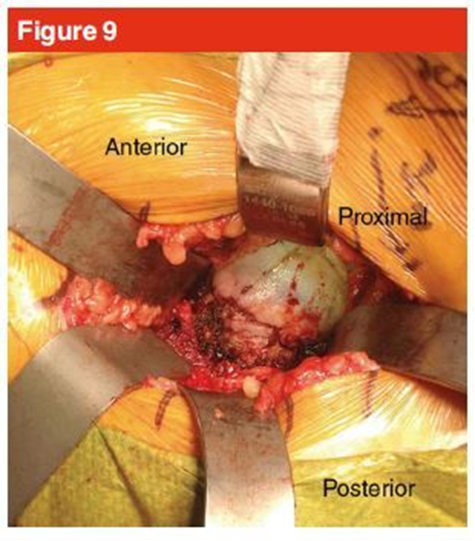 手术技巧：人工髋关节置换术，骨科医生须掌握！