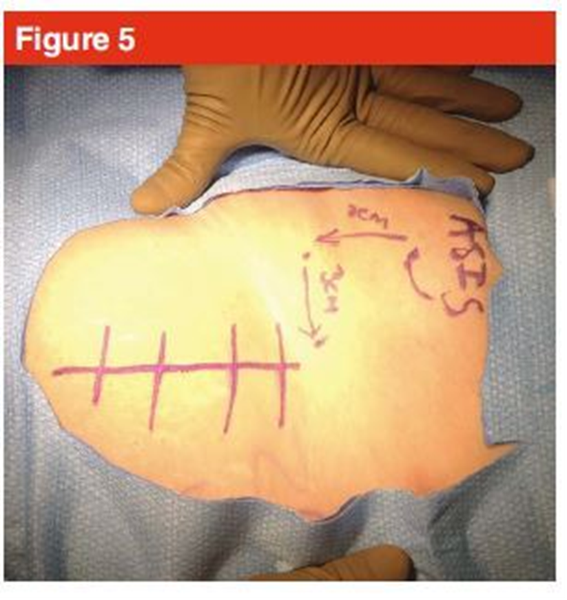 手术技巧：人工髋关节置换术，骨科医生须掌握！