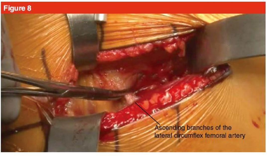 手术技巧：人工髋关节置换术，骨科医生须掌握！