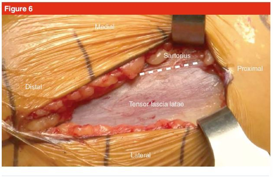 手术技巧：人工髋关节置换术，骨科医生须掌握！