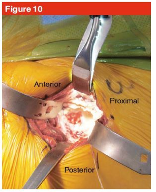 手术技巧：人工髋关节置换术，骨科医生须掌握！