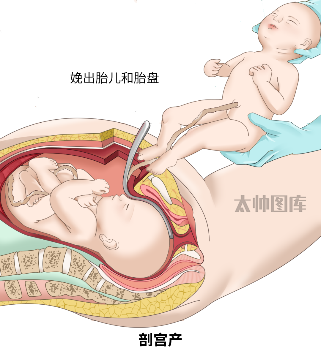 剖宫产手术拉勾怎么拉剖宫产手术【消毒范围、详细步骤、细节注意点】总结大全：建议小白反复观看_https://www.jmylbn.com_新闻资讯_第7张