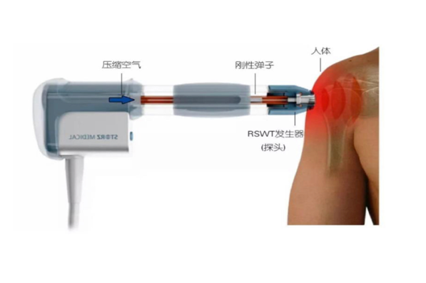 疼痛科怎么理疗丽江市人民医院疼痛科——理疗助力患者早日解除疼痛_https://www.jmylbn.com_新闻资讯_第2张