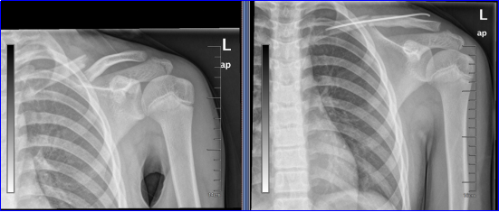 钛针是什么材料一根弹性钛针，为少年滑雪手的梦想“接骨”_https://www.jmylbn.com_新闻资讯_第3张