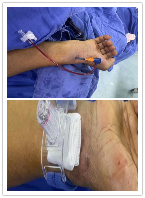 介入怎么进导管带您走进介入手术室，近距离了解冠脉介入手术_https://www.jmylbn.com_新闻资讯_第10张