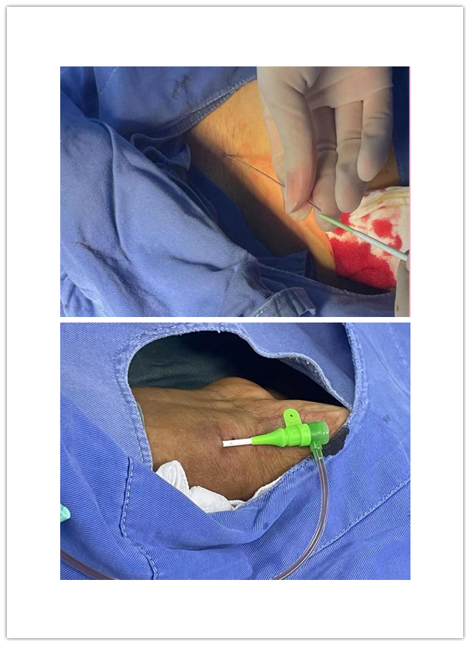 介入怎么进导管带您走进介入手术室，近距离了解冠脉介入手术_https://www.jmylbn.com_新闻资讯_第3张