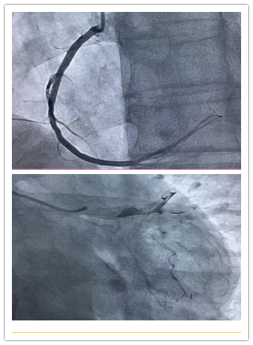 介入怎么进导管带您走进介入手术室，近距离了解冠脉介入手术_https://www.jmylbn.com_新闻资讯_第5张