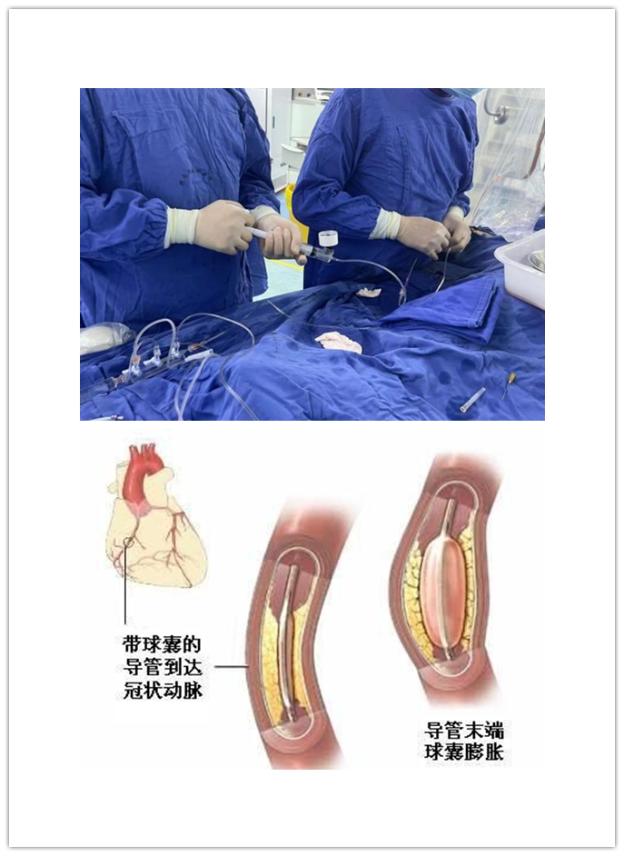 介入怎么进导管带您走进介入手术室，近距离了解冠脉介入手术_https://www.jmylbn.com_新闻资讯_第8张