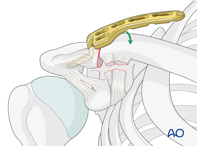 锁骨钩板真的过时了吗？怎么才能避免并发症？