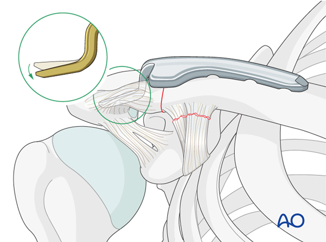锁骨钩板真的过时了吗？怎么才能避免并发症？