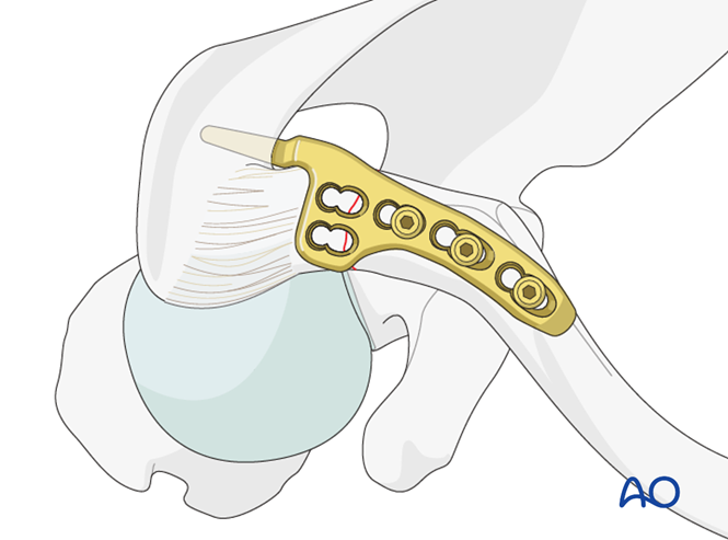 锁骨钩板真的过时了吗？怎么才能避免并发症？