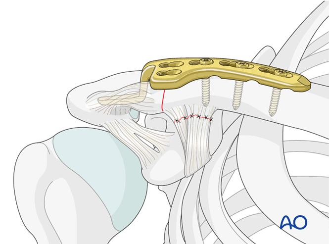 锁骨钩板真的过时了吗？怎么才能避免并发症？