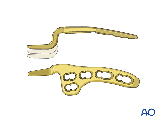 锁骨钩板真的过时了吗？怎么才能避免并发症？