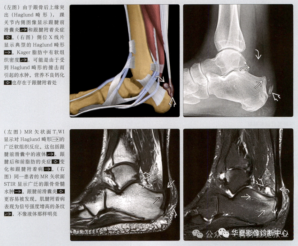 跟腱断裂谁之罪----Haglund综合征，“封闭针”岂能背锅？
