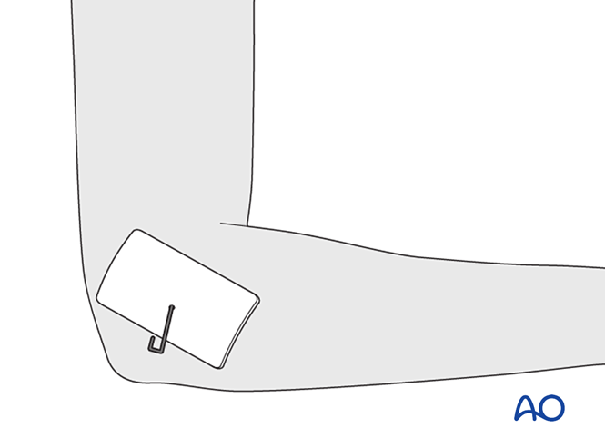 AO儿童骨折治疗原则，高清美图欣赏
