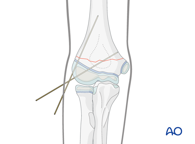 AO儿童骨折治疗原则，高清美图欣赏
