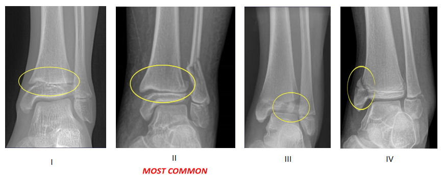AO儿童骨折治疗原则，高清美图欣赏