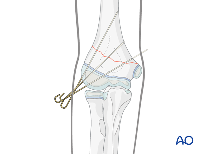 AO儿童骨折治疗原则，高清美图欣赏