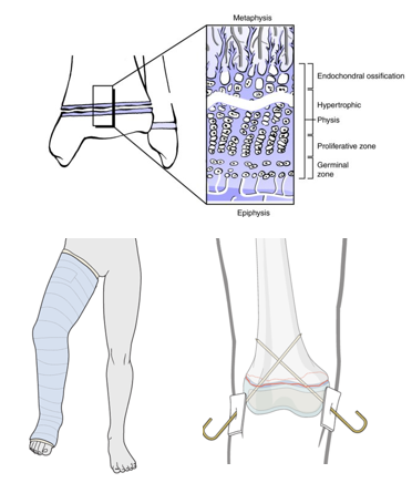 AO儿童骨折治疗原则，高清美图欣赏