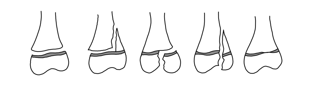AO儿童骨折治疗原则，高清美图欣赏