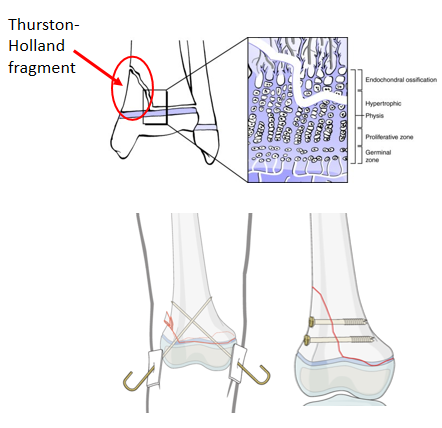 AO儿童骨折治疗原则，高清美图欣赏