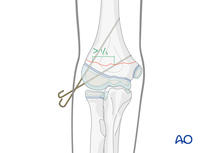 AO儿童骨折治疗原则，高清美图欣赏