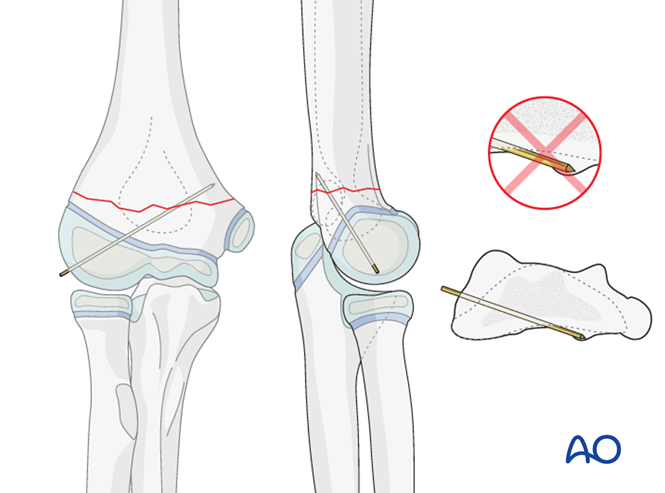 AO儿童骨折治疗原则，高清美图欣赏