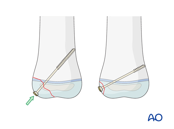AO儿童骨折治疗原则，高清美图欣赏