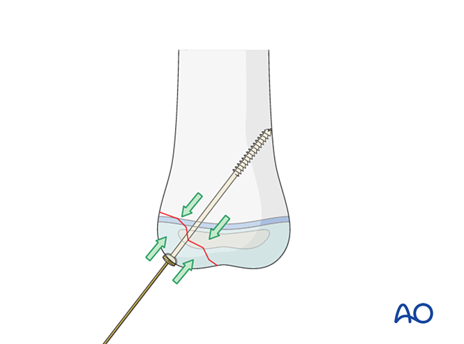 AO儿童骨折治疗原则，高清美图欣赏
