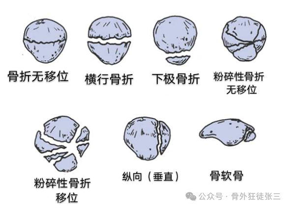 髌骨骨折，微创经皮空心钉的治疗