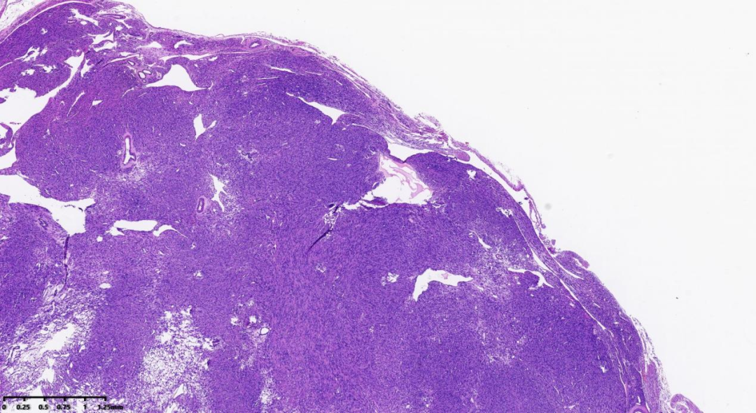 fh染色是什么意思病例分享 ｜ 延胡索酸水合酶（FH）缺陷型子宫平滑肌瘤_https://www.jmylbn.com_新闻资讯_第2张