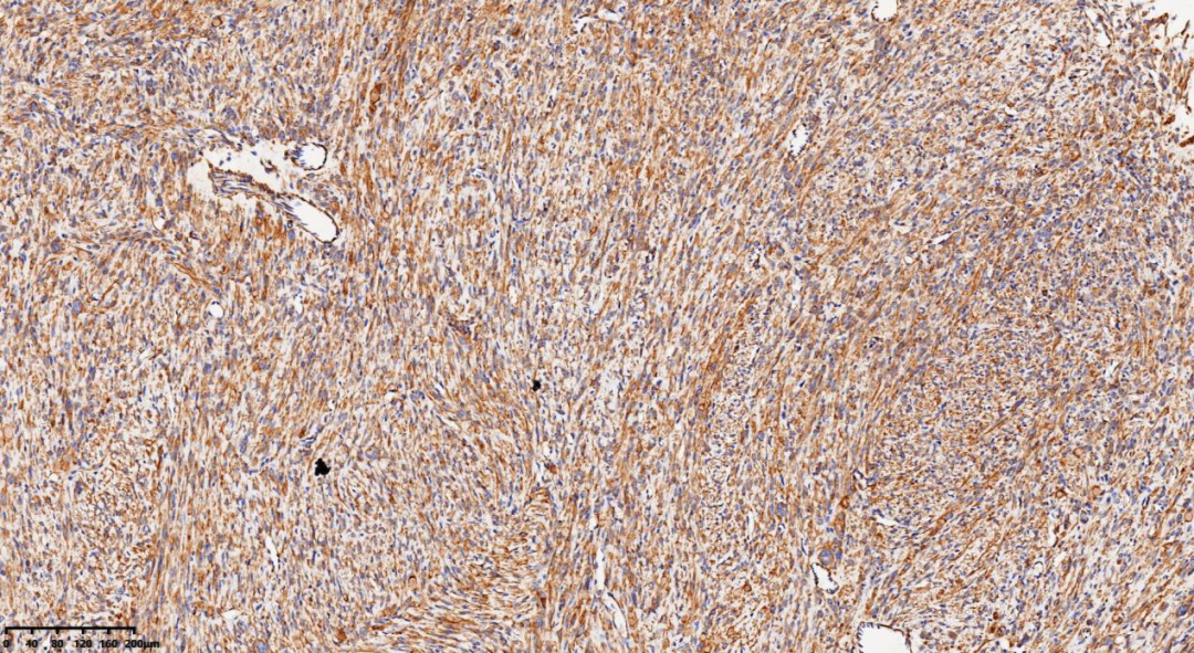 fh染色是什么意思病例分享 ｜ 延胡索酸水合酶（FH）缺陷型子宫平滑肌瘤_https://www.jmylbn.com_新闻资讯_第10张